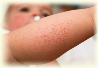 Urticaria la copii - înroșirea corpului și erupții cutanate sub formă de blistere