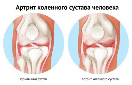 Tratamentul artritei la domiciliu, fără droguri în Samara