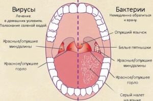 народни средства Лечение на фарингит, при възрастни рецепти