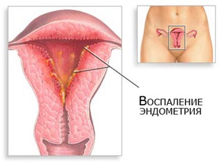 Tratamentul inflamației cervicale (cervicita) în orice stadiu al zonei litorale din Sankt Petersburg