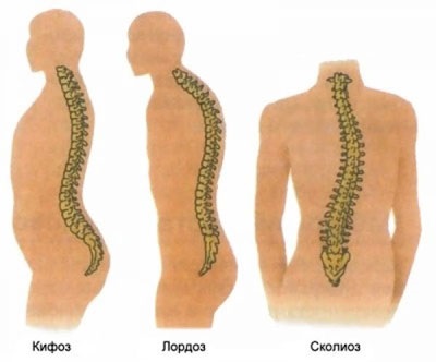 Lordoza coloanei vertebrale este normală sau patologia care trebuie tratată