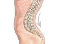 Lordoza coloanei vertebrale este normală sau patologia care trebuie tratată