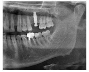 A mátrix egy innovatív anyag a kollagén alapon - a biotechnikai fogászati ​​implantátum rendszer