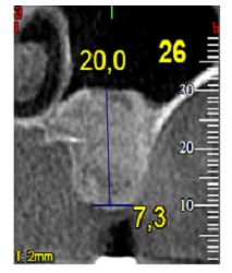 Matrix este un material inovator pe bază de colagen - sistemul de implant dentar biotehnic dentar