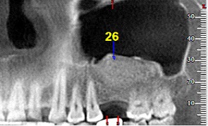 Matrix este un material inovator pe bază de colagen - sistemul de implant dentar biotehnic dentar