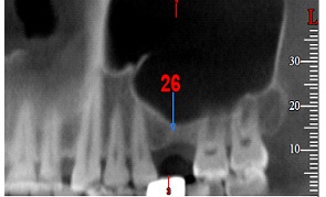 A mátrix egy innovatív anyag a kollagén alapon - a biotechnikai fogászati ​​implantátum rendszer