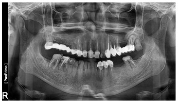 Matrix este un material inovator pe bază de colagen - sistemul de implant dentar biotehnic dentar