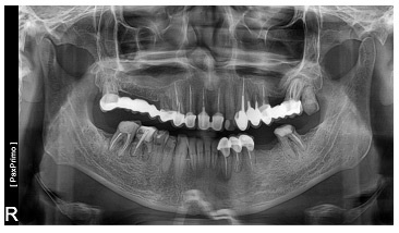 A mátrix egy innovatív anyag a kollagén alapon - a biotechnikai fogászati ​​implantátum rendszer