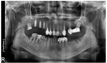 A mátrix egy innovatív anyag a kollagén alapon - a biotechnikai fogászati ​​implantátum rendszer