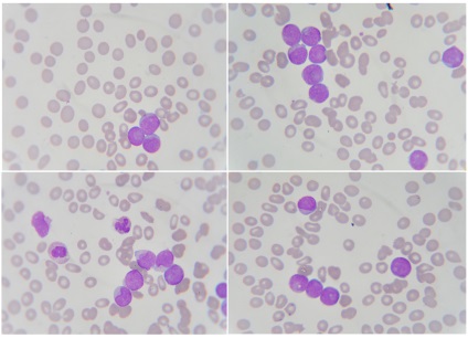 Medweb - medicii au vindecat leucemia cu HIV