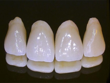 Ceramica metalica pe dinti - care, cine si cum