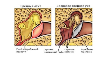 El tudok menni a fürdőbe otitis, úszni és mosni a hajam?