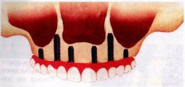 Musheev_practical fogászati ​​implantológia