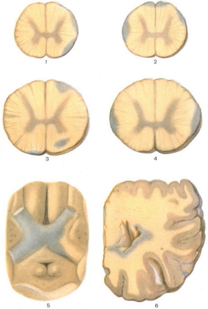 Anatomia patologică a sclerozei multiple