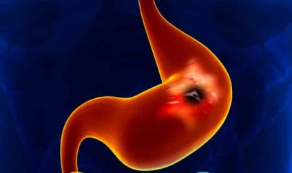 Ulcerul gastric perforat - faza bolii