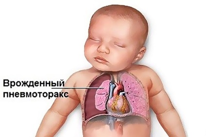 Pneumotoraxul cauzei, simptomelor și tratamentului ușor - Info pentru sănătate