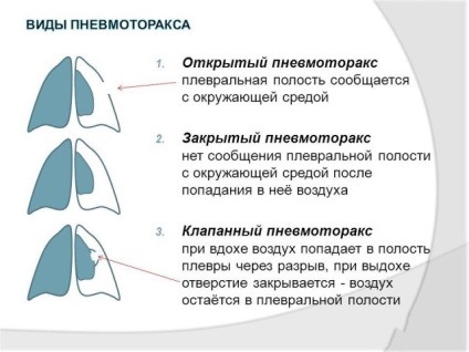 Pneumotoraxul cauzei, simptomelor și tratamentului ușor - Info pentru sănătate