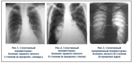 Pneumotoraxul cauzei, simptomelor și tratamentului ușor - Info pentru sănătate