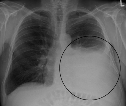 Pneumotoraxul cauzei, simptomelor și tratamentului ușor - Info pentru sănătate