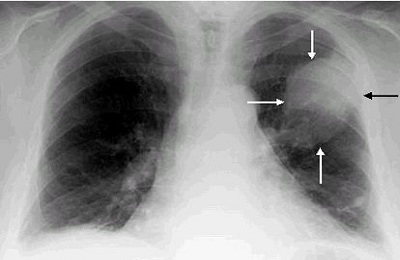 Are fluorografia cancerului pulmonar și cum arată tumoarea în imagine