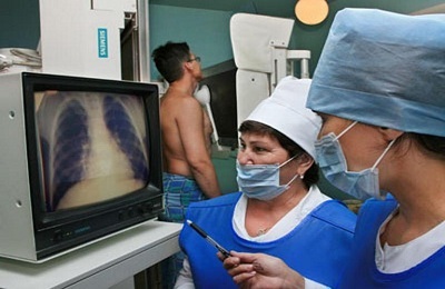 Are fluorografia cancerului pulmonar și cum arată tumoarea în imagine