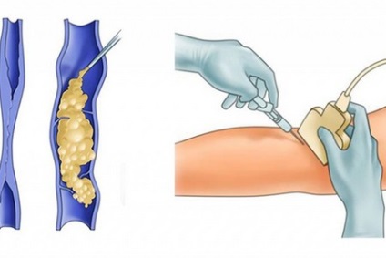 A posztinjektív thrombophlebitis gyulladás esetén tüneteket és kezelést okoz