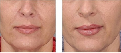 Juvederm gyógyszer - típusok, kritikák, fotók