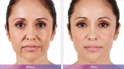 Juvederm gyógyszer - típusok, kritikák, fotók