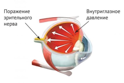 Semnele de simptome glaucom-ochi sunt tratamentul, care a efectuat prima operație, laser, metode populare