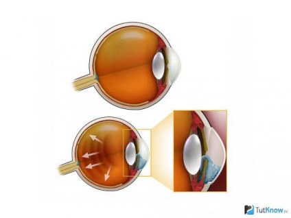 Semnele de simptome glaucom-ochi sunt tratamentul, care a efectuat prima operație, laser, metode populare