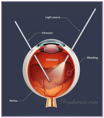 Semnele de simptome glaucom-ochi sunt tratamentul, care a efectuat prima operație, laser, metode populare