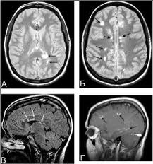 Scleroza multiplă, anatomia patologică și hematologia