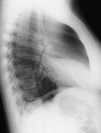 Diagnosticul cu raze X a pneumoniei comunitare la copii