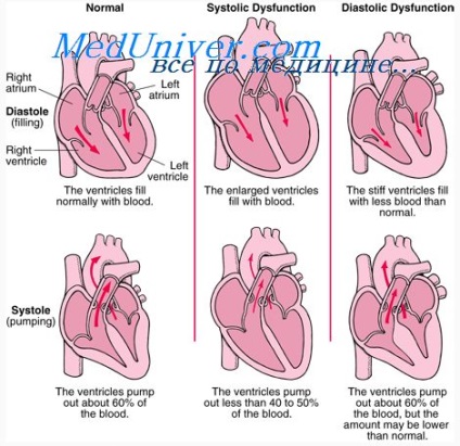 Efectul cardiac după infarct