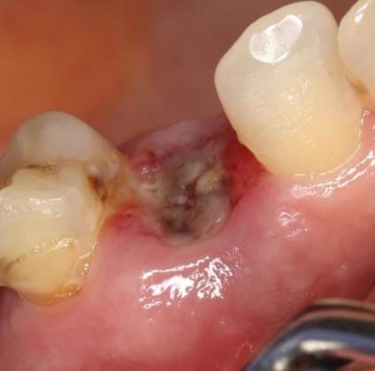 Conurile de pe gingii după extracția dinților cauzează o descriere a complicațiilor