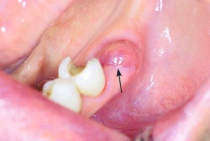 Conurile de pe gingii după extracția dinților cauzează o descriere a complicațiilor
