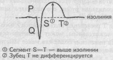 Etapele infarctului miocardic infarct miocardic cu focalizare mare au o etapă consecutivă