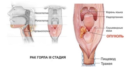 Gradele de cancer la gât, principalele simptome și cauze ale bolii