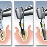 Stomatologie în China, tratament dentar în China, yangji china