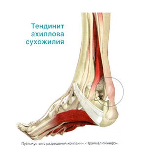 Achilles ín tendonitis