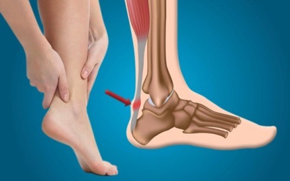 A tendinitis Achilles-ín okoz, tüneteket és kezelést