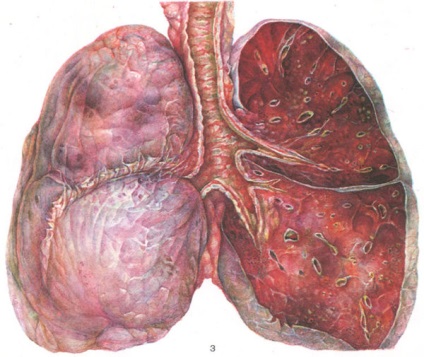 Traheobronchitis Simptome, curs și metode de tratament