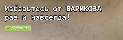 Тромбофлебит крак тромбоза на дълбоките вени симптоми (снимка), лечение на разширени вени