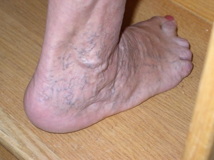 Тромбофлебит крак тромбоза на дълбоките вени симптоми (снимка), лечение на разширени вени