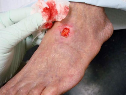 Тромбофлебит крак тромбоза на дълбоките вени симптоми (снимка), лечение на разширени вени