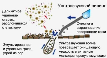 Ультразвукова чистка обличчя відгуки, фото до і після, протипоказання