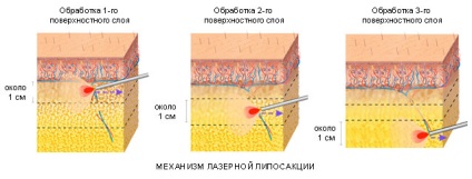 Vacuum (aspirat) liposucție este un chirurg plastic de sweeps cu