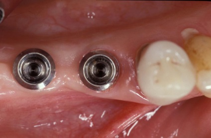 Opțiuni de conectare, implantarium