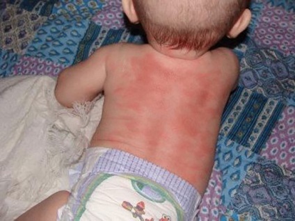 Erupții pe pielea unui copil sub formă de urticarie și erupții foto pe corpul copiilor cu explicații