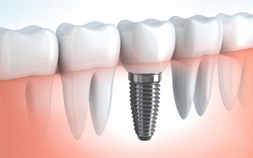 Restaurarea implantării dinților